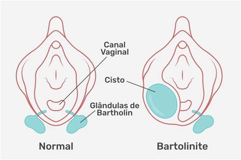 glândulas de bartholin e de skene|Glândula de Bartholin: cisto, abscesso e bartolinite